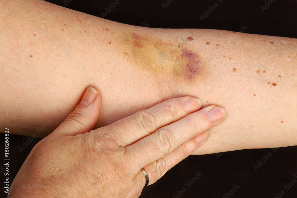 Fototapeta premium Ein Hämatom am Arm einer Frau. Ein großer blauer Fleck am Arm