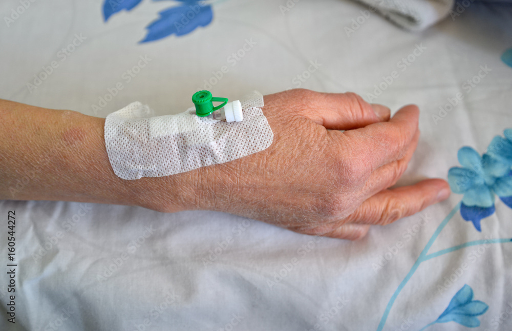 Peripheral intravenous catheter for vascular access placed in a vein on