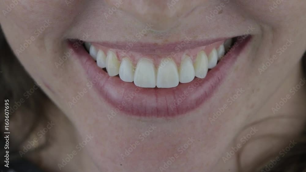 the patient's smile, temporary installation of slips before veneers in dental clinic. Сeramic veneers after fixation. Color A2. Natural color. the patient's smile, temporary installation of slips before veneers in dental clinic. Сeramic veneers after fixation. Color A2. Natural color.