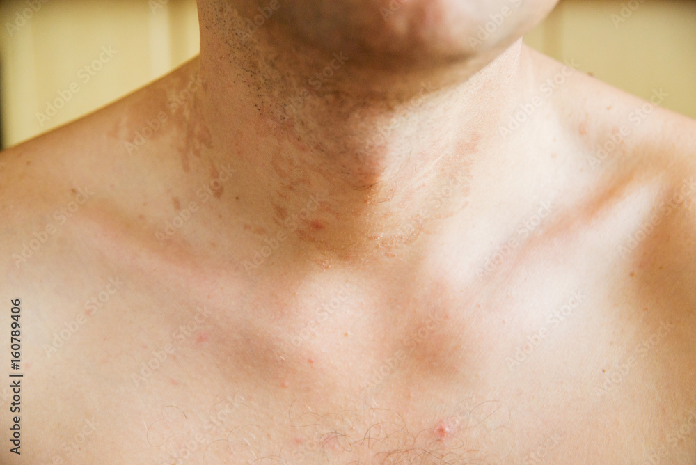 dermatitis skin dermatitis skin