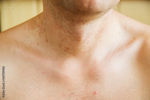 dermatitis skin