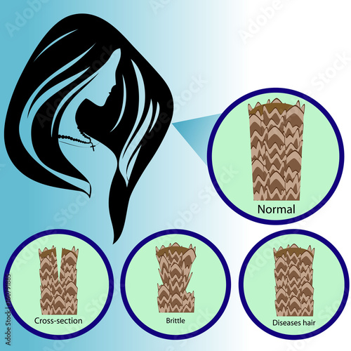Hair follicle. Cross-section, brittle, loss, diseases hair