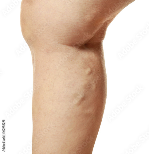 Human leg on white background, closeup. Varicose veins concept