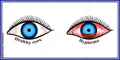 Hyphema - hemorrhage in the anterior chamber of the eye.