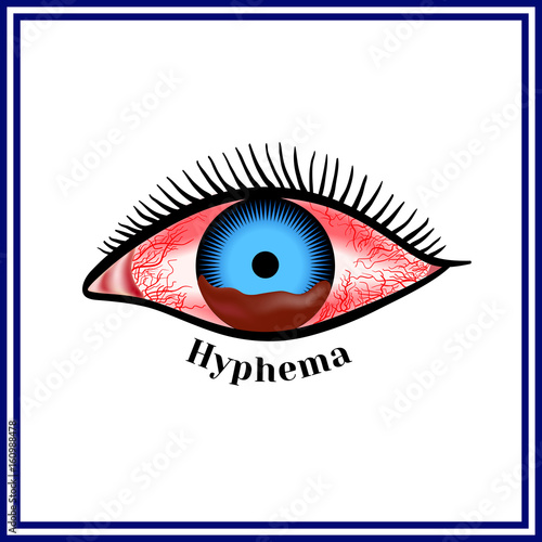 Hyphema - hemorrhage in the anterior chamber of the eye.