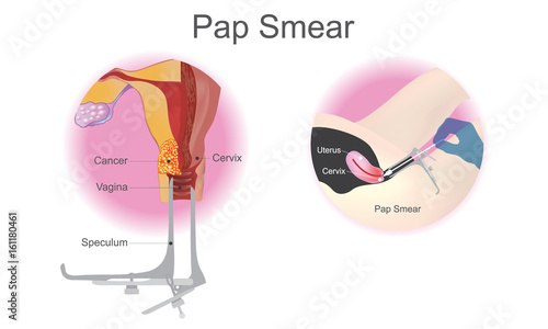 Pap smear is a screening procedure for cervical cancer. Vector design. photo
