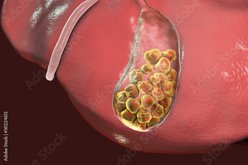 Gallstones, 3D illustration showing bottom view of liver and gallbladder with stones photo