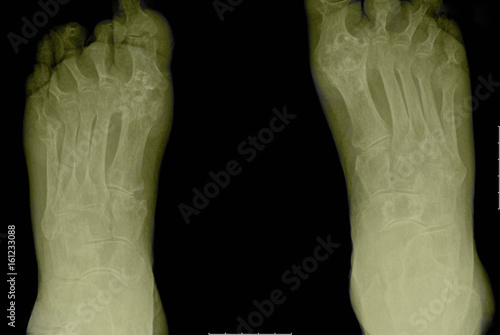 X-ray showing arthritic feet photo