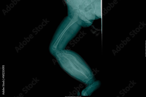 X-ray of infantile cortical hyperostosis