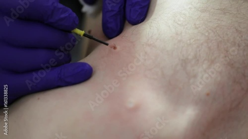 Doctor removing mole in surgical procedure. photo