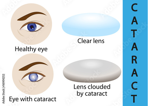 A cataract is an clouding crystalline lens inside the eye.
