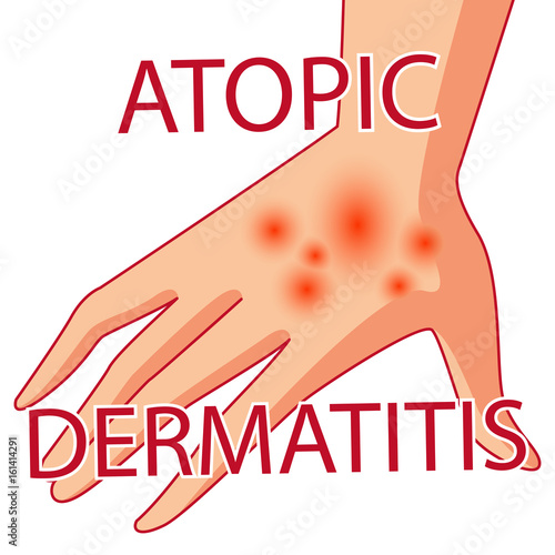 atopic dermatis. The person scratches the arm on which is atopic dermatitis. Itching. Colored vector illustration of a skin lesion, itchy skin.