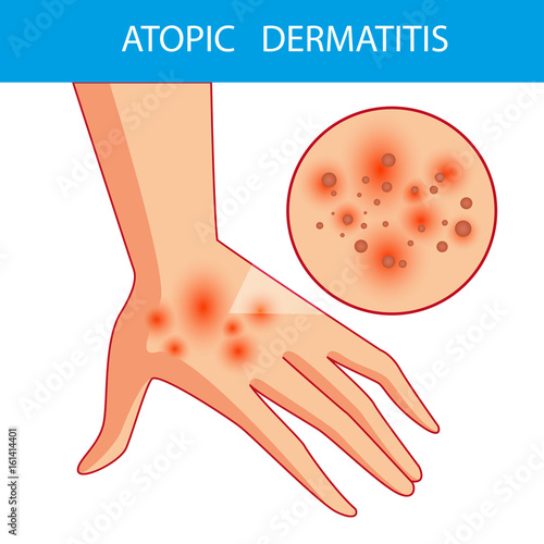 atopic dermatis. The person scratches the arm on which is atopic dermatitis. Itching. Colored vector illustration of a skin lesion, itchy skin.