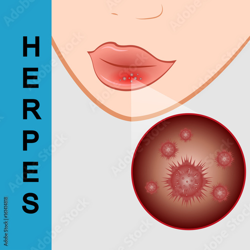 lips closeup with cold herpes, sore on the lip