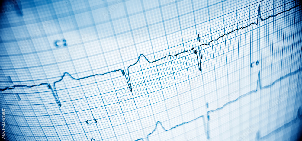 Electrocardiogram Electrocardiogram