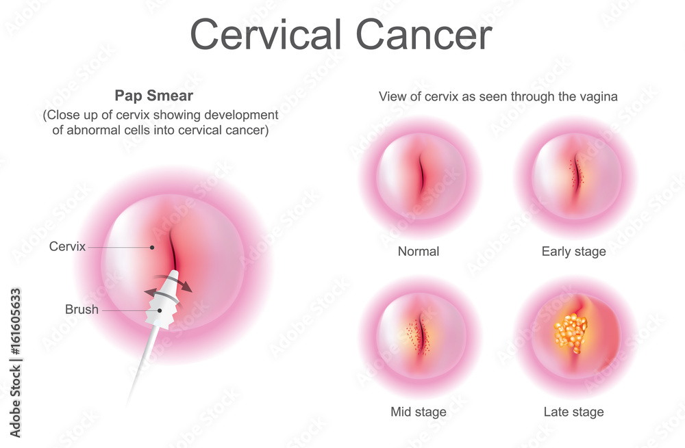 © PATTARAWIT - Stage of Cervical cancer. Education info graphic vector. © PATTARAWIT - Stage of Cervical cancer. Education info graphic vector.