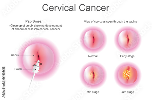 Stage of Cervical cancer. Education info graphic vector.