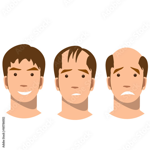 Stages of baldness.