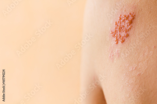 Shingles on men herpes zoster. Closeup. photo