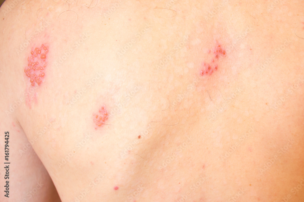 Shingles on men herpes zoster. Closeup.