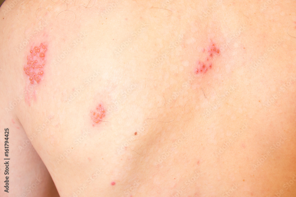 Fototapeta premium Shingles on men herpes zoster. Closeup.