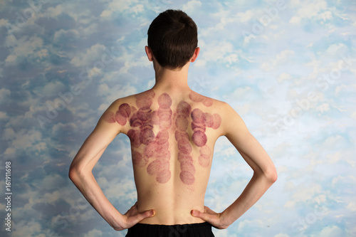 Young man back after marking of vacuum cupping, sport therapy photo