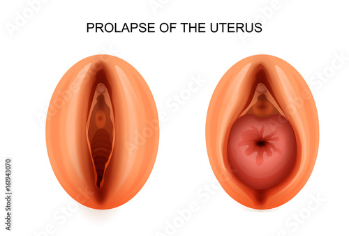 prolapse of the uterus. gynecology photo
