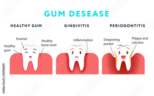 Step of gum disease. Healthy tooth and gingivitis.. Cute cartoon design, illustration isolated on blue background.