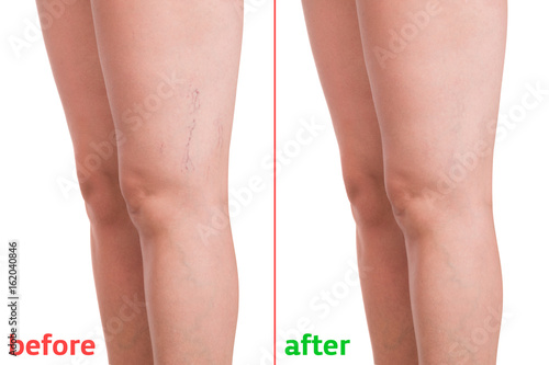 Varicose veins photo