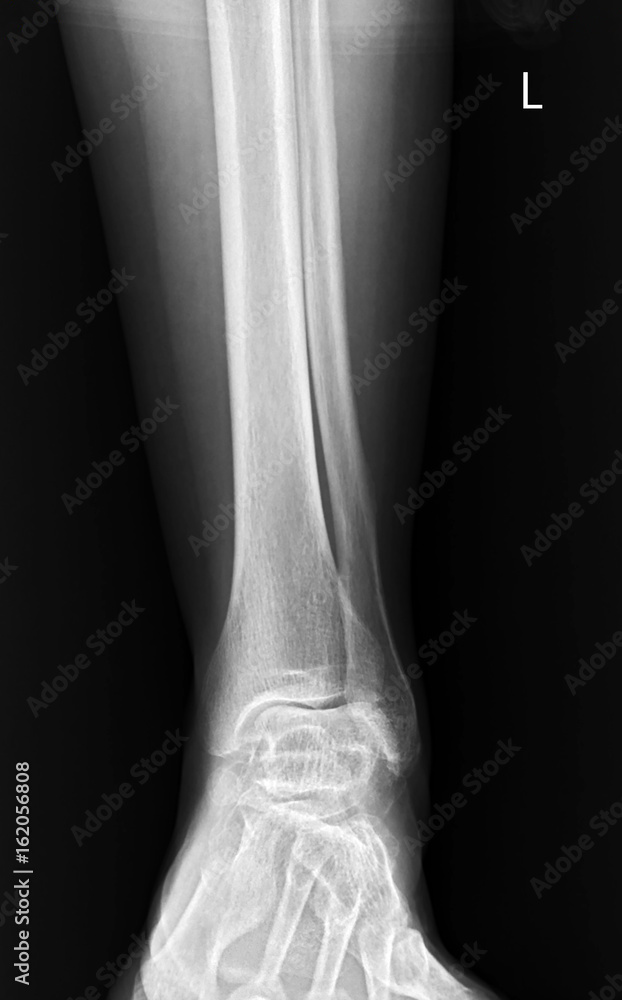 x-ray of human leg and ankle x-ray of human leg and ankle