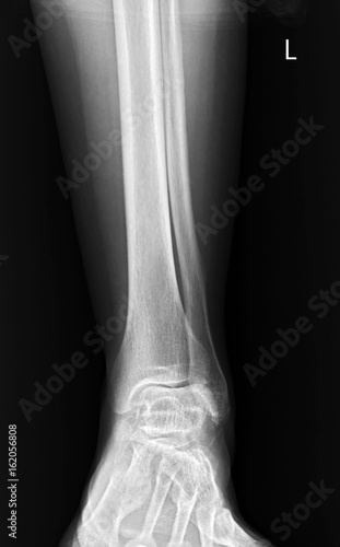 x-ray of human leg and ankle