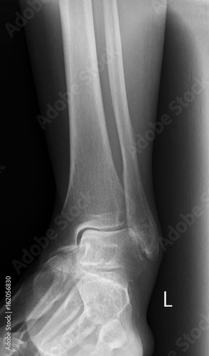 x-ray of human leg and ankle