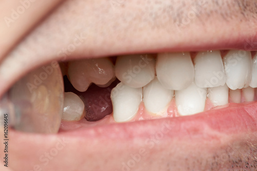 Obraz na płótnie Teeth with gap of missing tooth