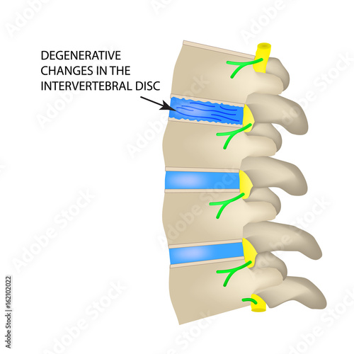 Degenerative changes in the intervertebral disc. Vector illustration on isolated background photo