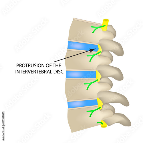 Protrusion of the intervertebral disc. Vector illustration on isolated background