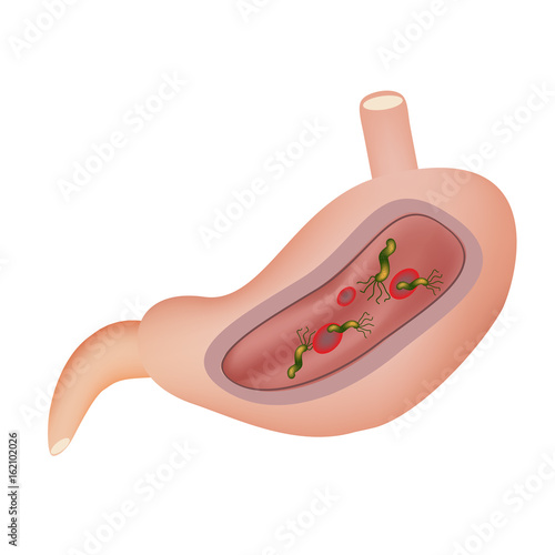 Stomach. Helicobacter pylori. Vector illustration on isolated background.