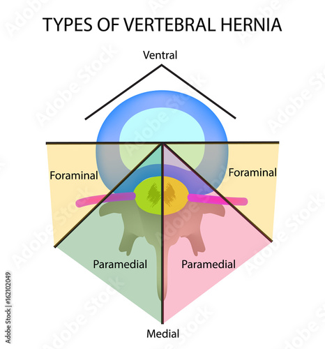 Types of location of the intervertebral hernia. Vector illustration on isolated background.