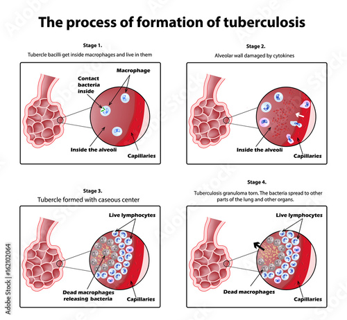 The process of tuberculosis formation. Infographics. Vector illustration on isolated background. photo