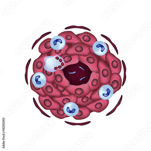 The structure of tuberculous granulomas. Vector illustration on isolated background