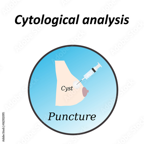 Diagnosis of breast cancer. World day against breast cancer. Cytology, biopsy, punctus. Infographics. Vector illustration on isolated background