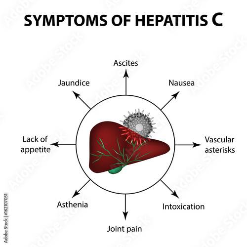 Symptoms of hepatitis C. Liver. World Hepatitis Day. July 28th. Infographics. Vector illustration on isolated background