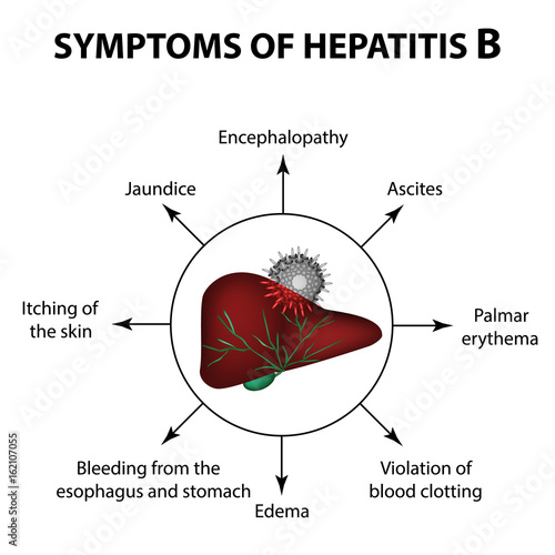 Symptoms of hepatitis B. Liver. World Hepatitis Day. July 28th. Infographics. Vector illustration on isolated background