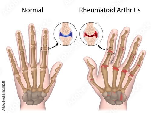 Rheumatoid arthritis of hand photo