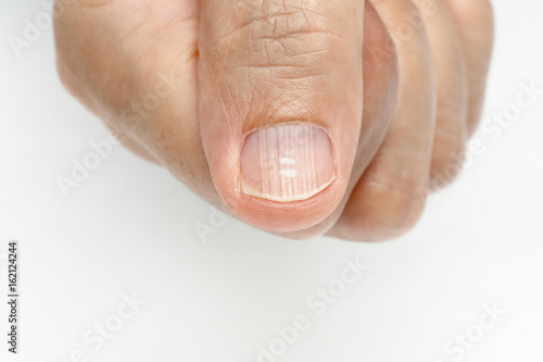 Fotografia White spots and Vertical ridges on the fingernails symptoms deficiency vitamins