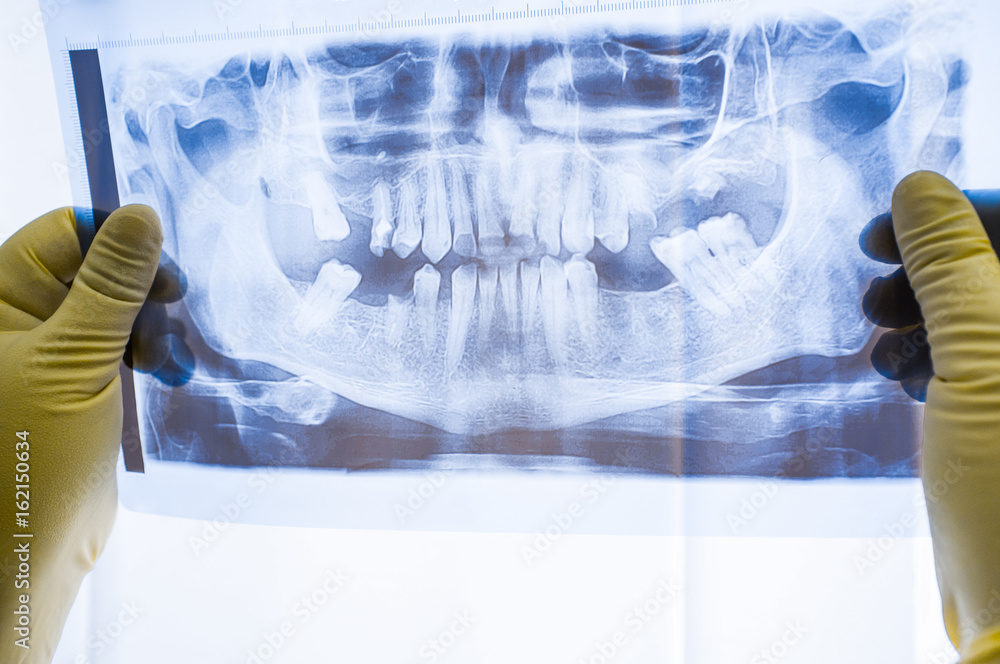 Full mouth panoramic in Xray, showing all the teeth. Doctor studying