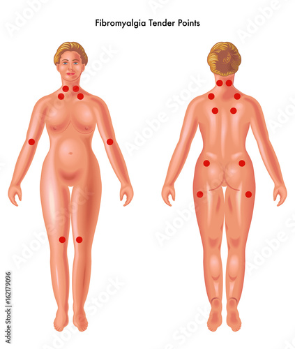 vector medical illustration of Fibromyalgia tender points