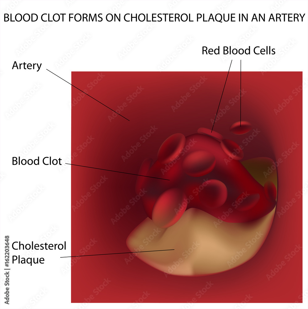 Blood clot forms on cholesterol plaque in artery Stock Illustration