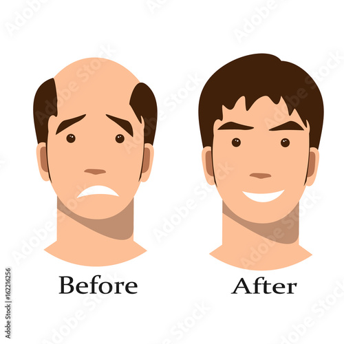 Men thinning hair treatment before and after