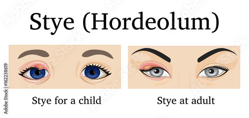 Illustration of Stye