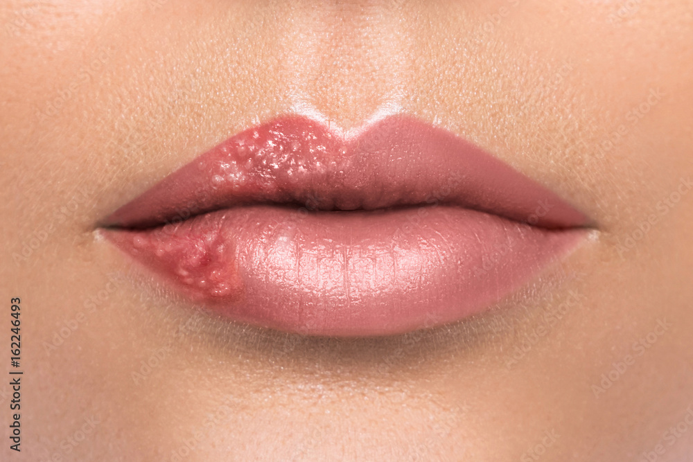 Fototapeta premium Female lips affected by herpes virus